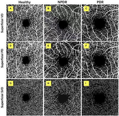 Retinal and choroidal microvascular characterization and density changes in different stages of diabetic retinopathy eyes